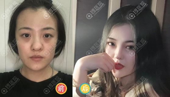 张家口维多利亚张宝誉隆鼻案例 张家口维多利亚张宝誉隆鼻案例