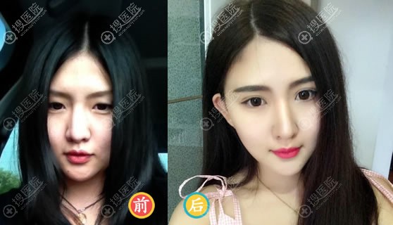 张家口维多利亚王亚勇双眼皮案例 张家口维多利亚王亚勇双眼皮案例