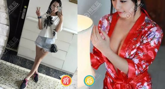 维多利亚李启飞自体脂肪隆胸案例 维多利亚李启飞自体脂肪隆胸案例