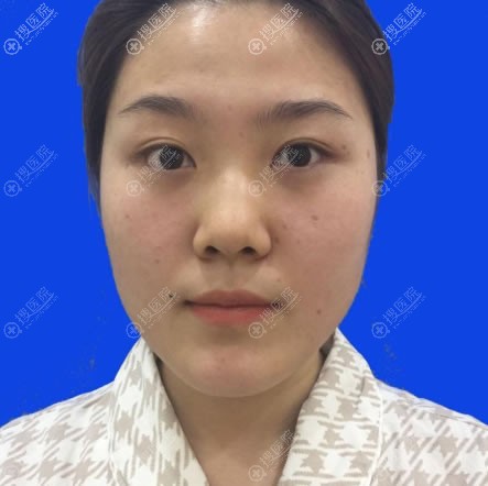 和大家聊聊这次去张家口维多利亚医院做鼻综合隆鼻手术的经历