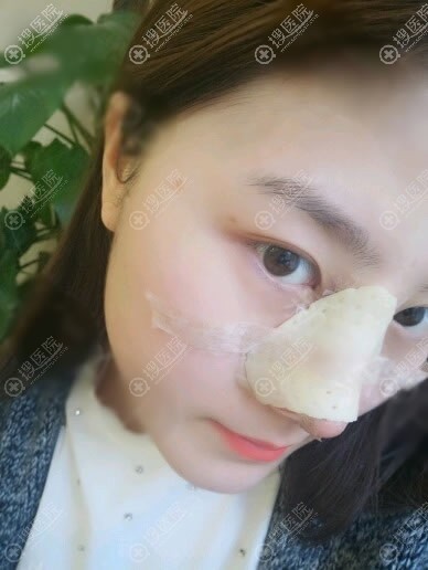 张家口维多利亚隆鼻即刻效果 张家口维多利亚隆鼻即刻效果