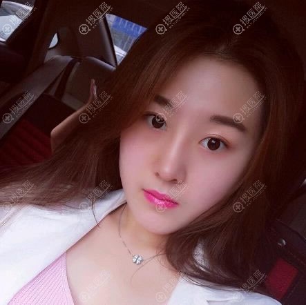 张家口维多利亚整形隆鼻案例 张家口维多利亚整形隆鼻案例