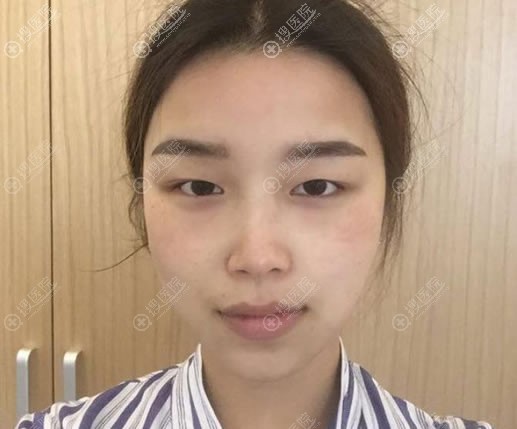 从4个月效果来看找张家口维多利亚美容院张立平割双眼皮没毛病