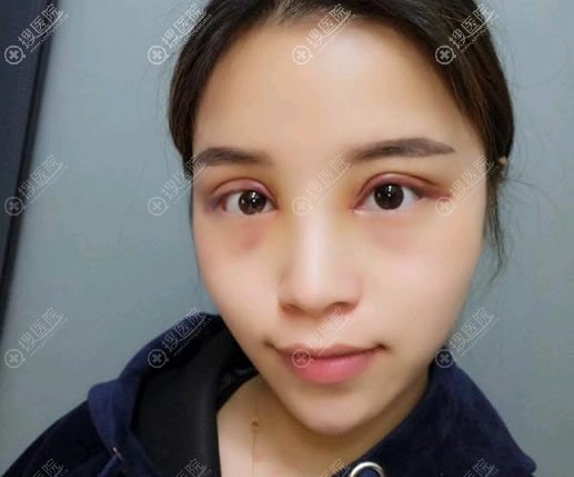 张家口维多利亚双眼皮手术即刻效果 张家口维多利亚双眼皮手术即刻效果