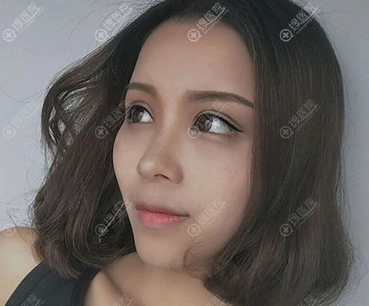 张家口维多利亚张立平双眼皮案例 张家口维多利亚张立平双眼皮案例