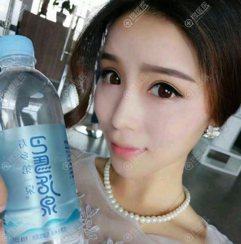 张家口维多利亚做双眼皮案例 张家口维多利亚做双眼皮案例