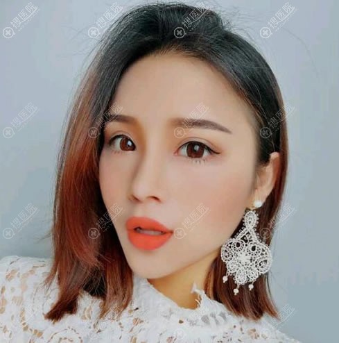 张家口维多利亚张立平眼综合案例 张家口维多利亚张立平眼综合案例