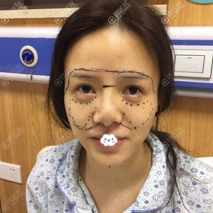 花1W6价格找成都西区医院毛健清做自体脂肪面部填充1年恢复图