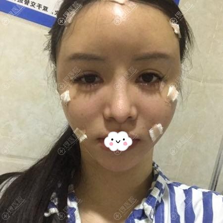 成都市西区医院自体脂肪面部填充术后效果 成都市西区医院自体脂肪面部填充术后效果