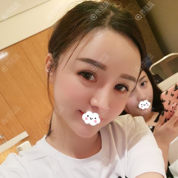 成都市西区医院自体脂肪面部填充怎么样?毛健清案例 成都市西区医院自体脂肪面部填充怎么样?毛健清案例