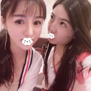 成都西区医院自体脂肪面部填充术后15天效果 成都西区医院自体脂肪面部填充术后15天效果