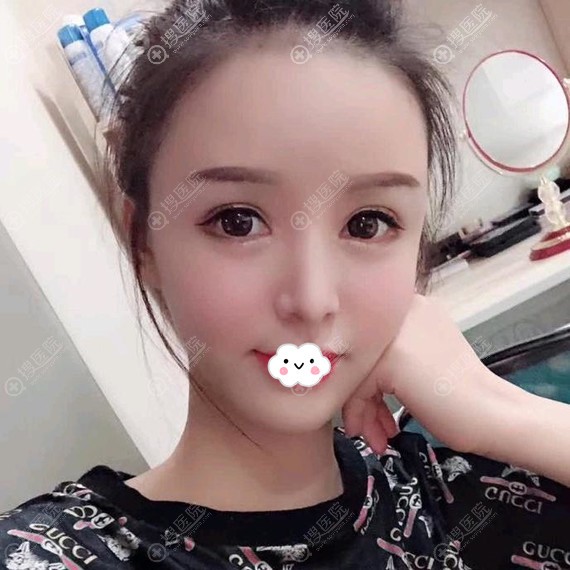 成都自体脂肪面部填充哪家好?成都市西区医院毛健清案例 成都自体脂肪面部填充哪家好?成都市西区医院毛健清案例