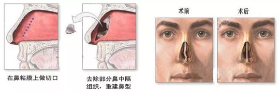上海伯思立医院鼻中隔偏曲修复示意图 上海伯思立医院鼻中隔偏曲修复示意图