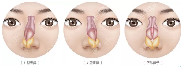 上海伯思立整形医院鼻中隔偏曲示意图 上海伯思立整形医院鼻中隔偏曲示意图