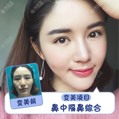 上海伯思立(百达丽)韩嘉毅做的鼻中隔隆鼻鼻综合隆鼻案例 上海伯思立(百达丽)韩嘉毅做的鼻中隔隆鼻鼻综合隆鼻案例