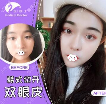 佛山医博士刘哲韩式切开双眼皮案例对比图 佛山医博士刘哲韩式切开双眼皮案例对比图