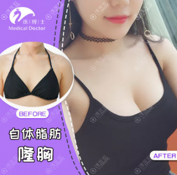 佛山医博士自体脂肪隆胸案例 佛山医博士自体脂肪隆胸案例