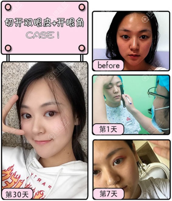 ��ɽҽ��ʿ����˫��Ƥ���۽ǰ���
