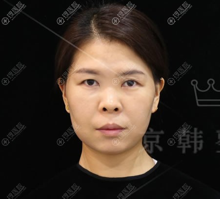 北京京韩张振做双眼皮效果如何?请看我的生物焊接双眼皮过程图