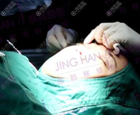 北京京韩张振做双眼皮过程图 北京京韩张振做双眼皮过程图