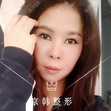 北京京韩整形张振双眼皮案例 北京京韩整形张振双眼皮案例