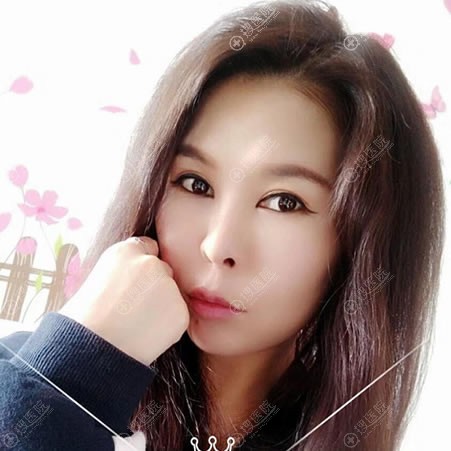 北京京韩整形做双眼皮案例图 北京京韩整形做双眼皮案例图