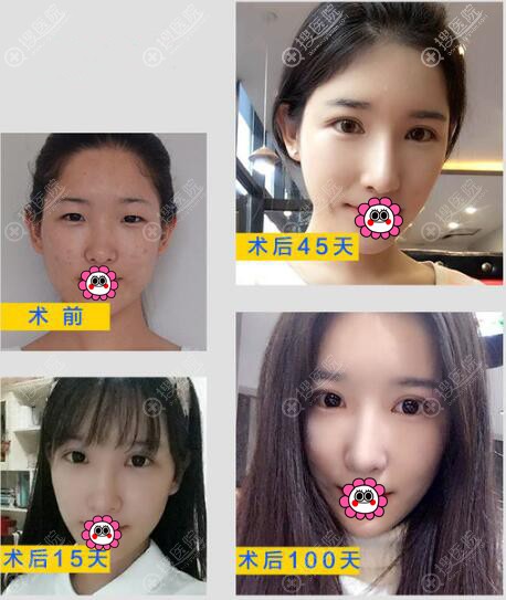 <!--<i data=20240710 data-id=12077></i>-->线雕提升案例对比效果 <!--<i data=20240710 data-id=12077></i>-->线雕提升案例对比效果