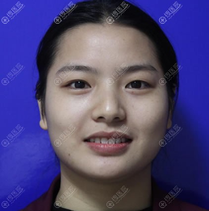 面诊上饶江洲华美医院王功槐后把双眼皮外眼角和内眼角一起开了