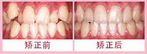 上海尤旦口腔隐适美牙齿矫正案例图 上海尤旦口腔隐适美牙齿矫正案例图