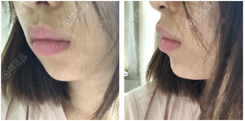 为了改善凸嘴我去上海尤旦口腔医院做了时代天使隐形牙齿矫正