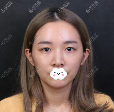 双眼皮术前素颜照片 双眼皮术前素颜照片