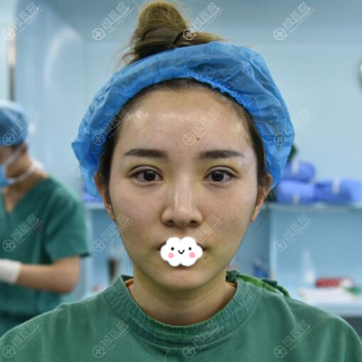 深圳美莱双眼皮术后即刻 深圳美莱双眼皮术后即刻