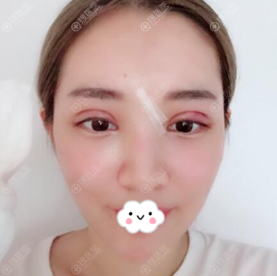 全切双眼皮术后天恢复效果 全切双眼皮术后天恢复效果