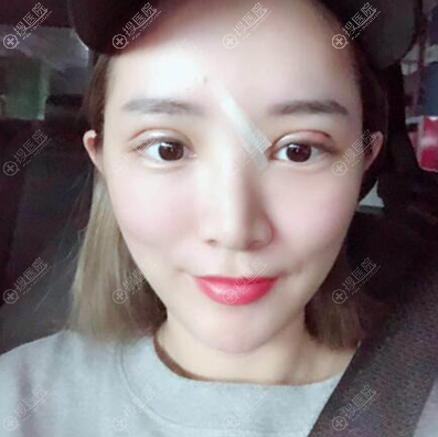 周洪波双眼皮术后4天 周洪波双眼皮术后4天