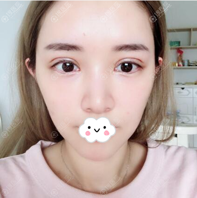 切开双眼皮拆线后恢复效果 切开双眼皮拆线后恢复效果
