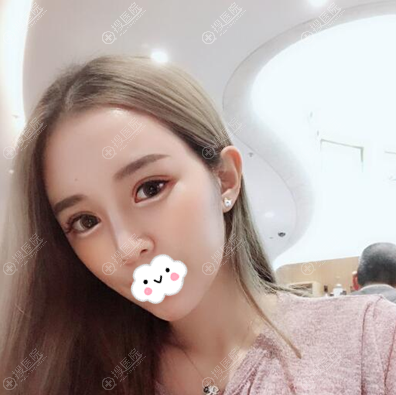 深圳美莱周洪超全切双眼皮术后40天 深圳美莱周洪超全切双眼皮术后40天