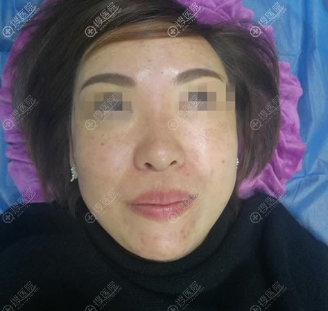 在哈尔滨成美做线雕隆鼻花费3K,做完后塌鼻梁和大鼻头都改善了