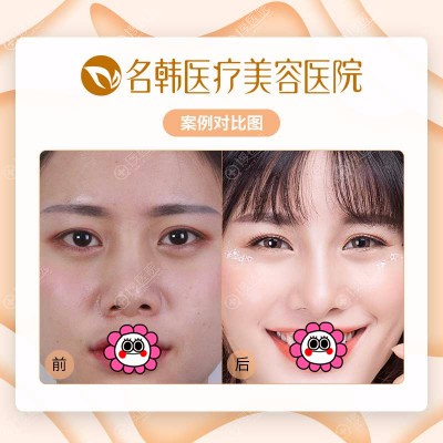 <!--<i data=20240710 data-id=12048></i>-->鼻部整形案例对比 <!--<i data=20240710 data-id=12048></i>-->鼻部整形案例对比