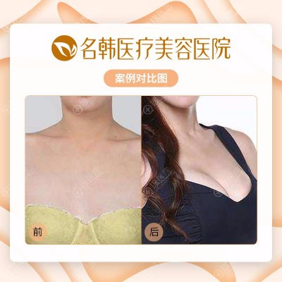<!--<i data=20240710 data-id=12048></i>-->丰胸前后对比 <!--<i data=20240710 data-id=12048></i>-->丰胸前后对比
