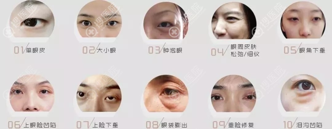 双眼皮需要改善的眼部问题 双眼皮需要改善的眼部问题