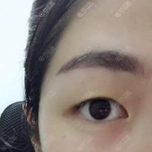 到<!--<i data=20240710 data-id=12048></i>-->做双眼皮术前照 到<!--<i data=20240710 data-id=12048></i>-->做双眼皮术前照