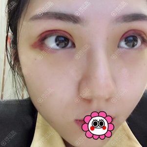 <!--<i data=20240710 data-id=12048></i>-->做双眼皮手术后3天 <!--<i data=20240710 data-id=12048></i>-->做双眼皮手术后3天