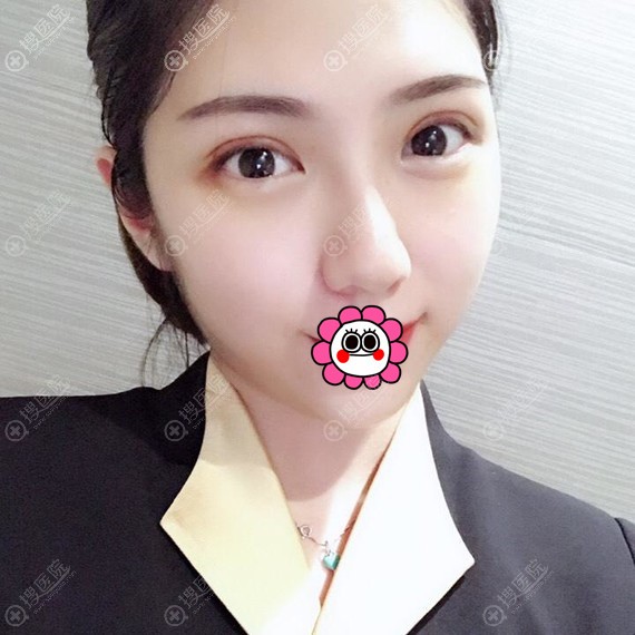 <!--<i data=20240710 data-id=12048></i>-->做全切双眼皮术后9天效果 <!--<i data=20240710 data-id=12048></i>-->做全切双眼皮术后9天效果