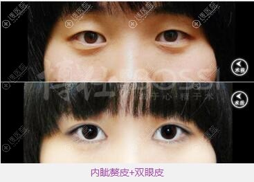 广州博仁张建军做的双眼皮术后眼睛更有神 广州博仁张建军做的双眼皮术后眼睛更有神