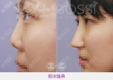 广州博仕李帅敏假体隆鼻前后对比 广州博仕李帅敏假体隆鼻前后对比