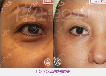 广州博仁高吉祛眼袋效果 广州博仁高吉祛眼袋效果
