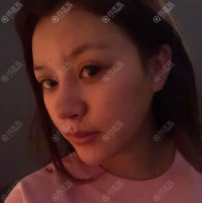 朋友说我找西安画美整形医院罗曼做完隆鼻后整个五官都变好看了