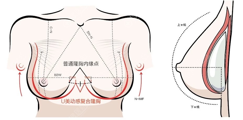 广州韩妃丰胸谁做的好?从内窥镜假体丰胸杨伟杰案例和价格来看
