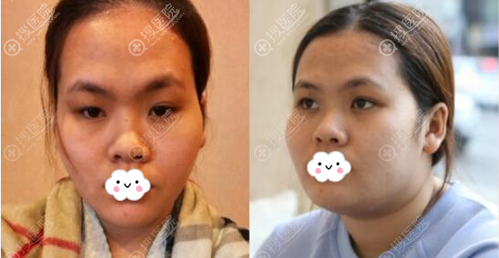 分享深圳回来医疗美容高卿豪脂肪面部填充术后2个月案例效果