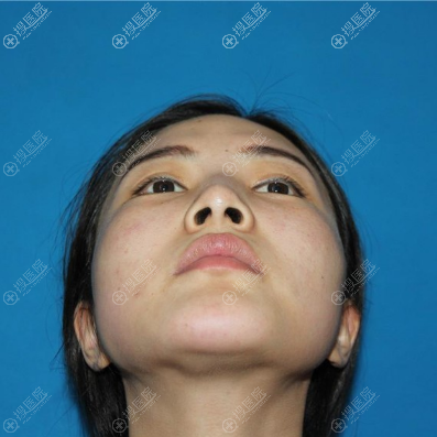 分享我去上海愉悦美联臣找刘先超做颧骨内推的亲身经历给大家